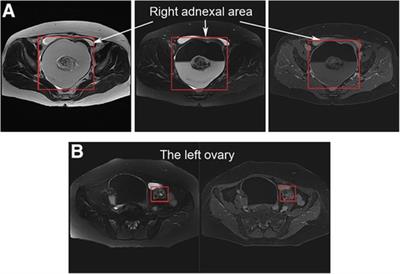 Struma ovarii with contralateral ovarian teratoma: A case report